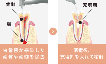 虫歯菌が感染した歯質や歯髄を除去し、消毒後充填剤を入れて密封