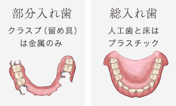 総入れ歯の場合、人工歯と床はプラスチック。部分入れ歯の場合、クラスプ（留め具）は金属のみ