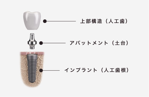 上部構造（人工歯）、アバットメント（土台）、インプラント（人工歯根）