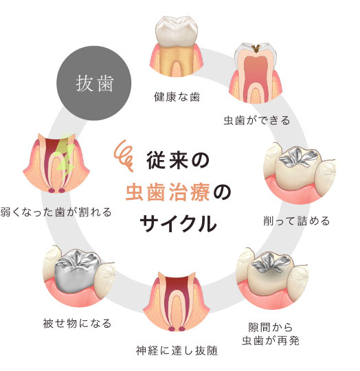 従来の虫歯治療のサイクル